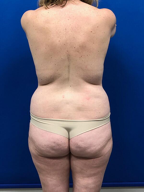 Buttock Augmentation & Buttock Shaping With SAFELipo BBL™ in
